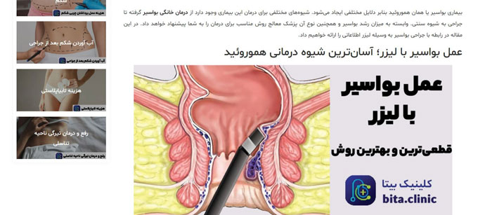 عمل هموروئید با لیزر کم توان